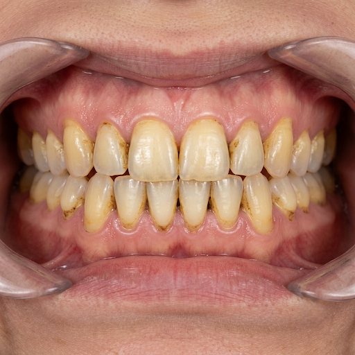 Before Whitening